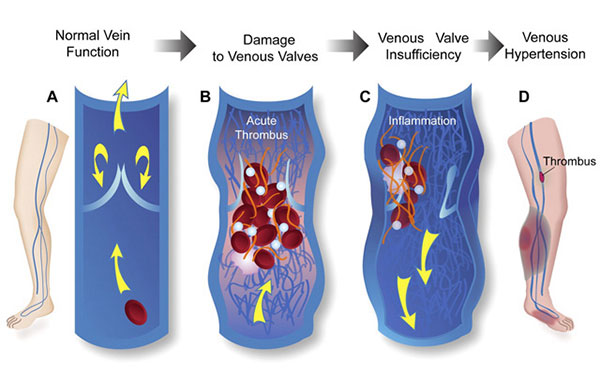 Two Most Common Categories of Vein Disease: Thrombosis and Insufficiency