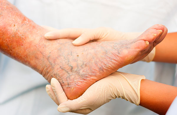 Troubling Facts About Vein Disease