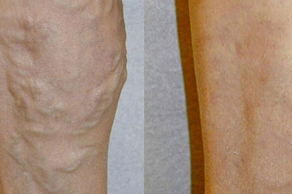 Natural remedies for varicose veins – scam or science?