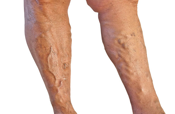 Four Most Common Vein Diseases