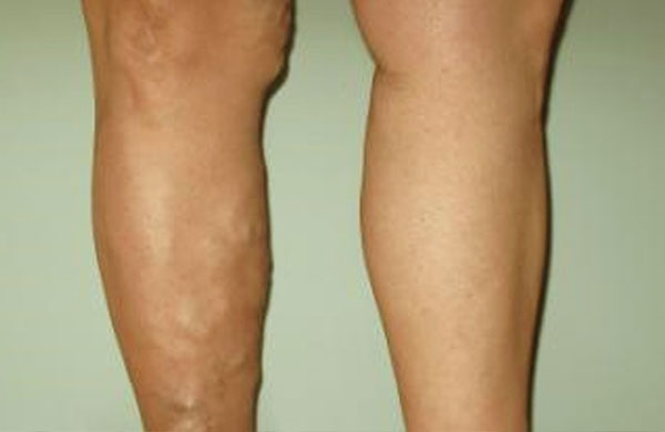 10 Little Known Facts About Vein Disease
