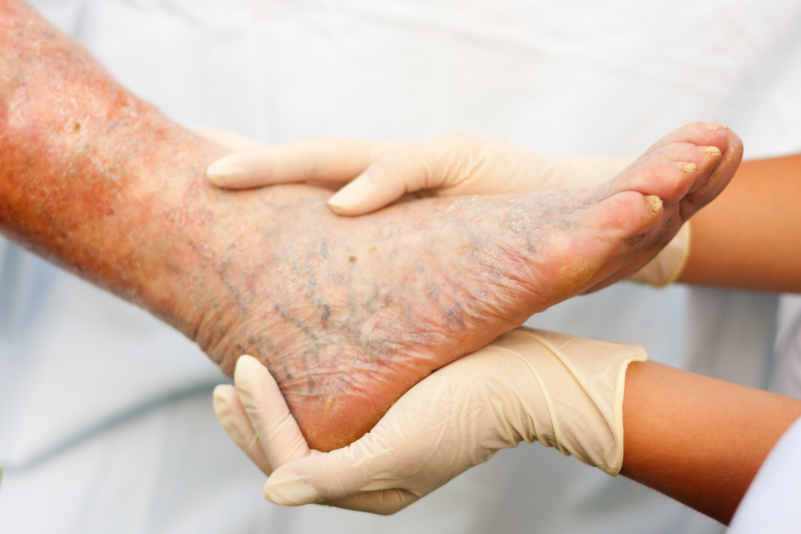 A Morristown, NJ Vascular Doctor Describes Unexpected Consequences of Swollen Legs and Ankles